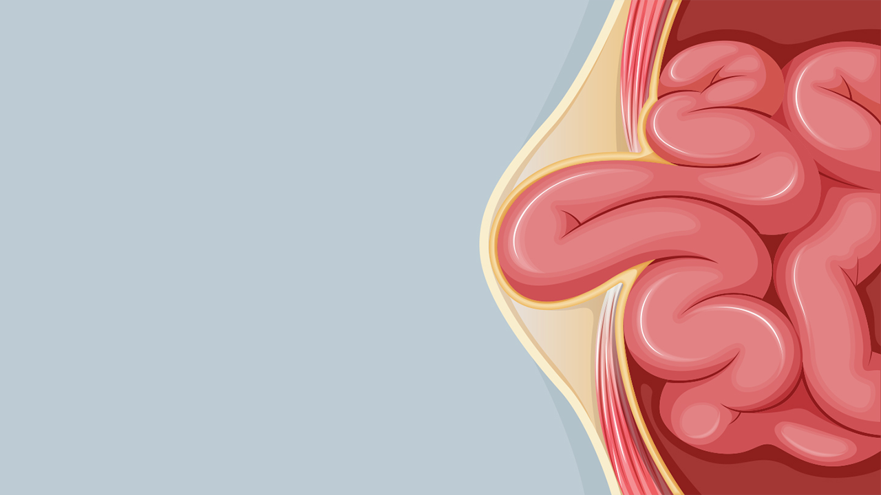 New Approaches, Trends Are Emerging in Hernia Repair