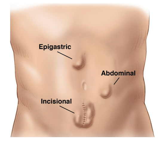 Ventral Hernia Repair