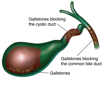 Cholecystectomy