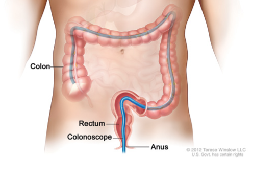 Colonoscopy