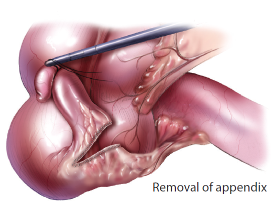 Appendectomy